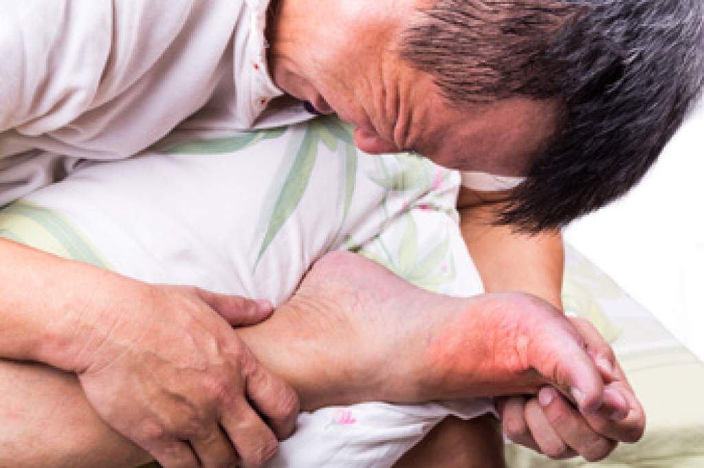 Understanding Gout Flares