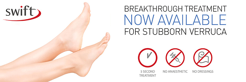 Swift Wart Treatment in the Los Angeles County, CA: Los Angeles, Beverly Hills, Culver City, Santa Monica, Marina Del Rey, Inglewood, Thousand Oaks, Burbank, Glendale, Pasadena, Malibu areas