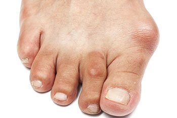 Bunions treatment in the Los Angeles County, CA: Los Angeles, Beverly Hills, Culver City, Santa Monica, Marina Del Rey, Inglewood, Thousand Oaks, Burbank, Glendale, Pasadena, Malibu areas