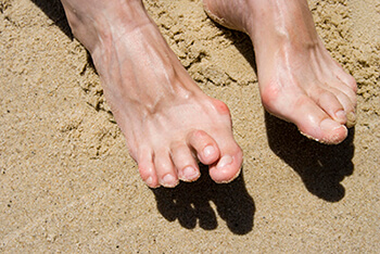hammertoes treatment in Los Angeles County, CA: Los Angeles, Beverly Hills, Culver City, Santa Monica, Marina Del Rey, Inglewood, Thousand Oaks, Burbank, Glendale, Pasadena, Malibu