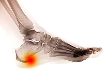 Heel spurs treatment in Los Angeles County, CA: Los Angeles, Beverly Hills, Culver City, Santa Monica, Marina Del Rey, Inglewood, Thousand Oaks, Burbank, Glendale, Pasadena, Malibu