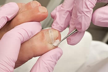 Ingrown toenails treatment in the Los Angeles County, CA: Los Angeles, Beverly Hills, Culver City, Santa Monica, Marina Del Rey, Inglewood, Thousand Oaks, Burbank, Glendale, Pasadena, Malibu areas
