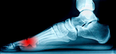 Mortons neuroma treatment in the Los Angeles County, CA: Los Angeles, Beverly Hills, Culver City, Santa Monica, Marina Del Rey, Inglewood, Thousand Oaks, Burbank, Glendale, Pasadena, Malibu areas