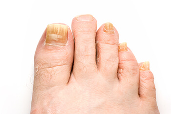 Fungus toenails treatment in the Los Angeles County, CA: Los Angeles, Beverly Hills, Culver City, Santa Monica, Marina Del Rey, Inglewood, Thousand Oaks, Burbank, Glendale, Pasadena, Malibu areas