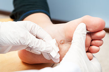 Plantar warts treatment in the Los Angeles County, CA: Los Angeles, Beverly Hills, Culver City, Santa Monica, Marina Del Rey, Inglewood, Thousand Oaks, Burbank, Glendale, Pasadena, Malibu areas