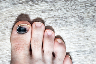Prevention and Podiatric Care for Runner’s Toenail