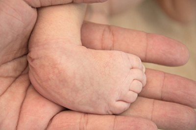 Different Types of Clubfoot in Infants
