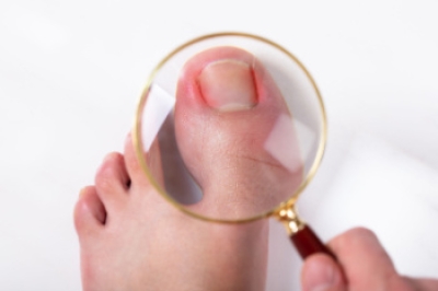 Symptoms and Causes of Ingrown Toenails