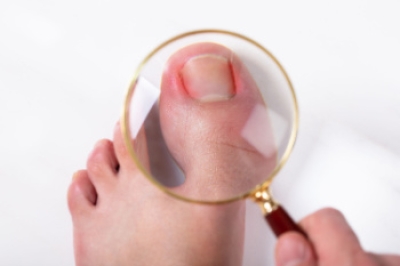 Causes and Treatment for Ingrown Toenails