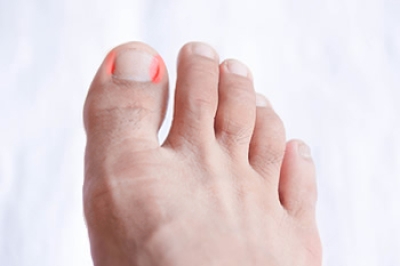 Causes and Symptoms of an Ingrown Toenail