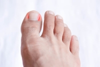 Causes and Symptoms of an Ingrown Toenail